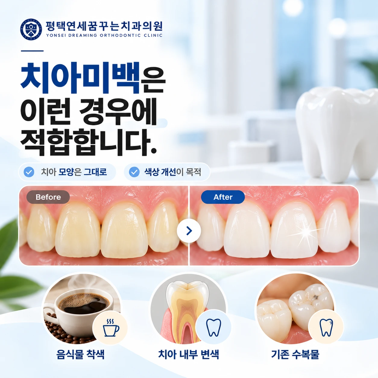 심미 진료 안내: 치아미백은 어떤 경우에 적합할까요?