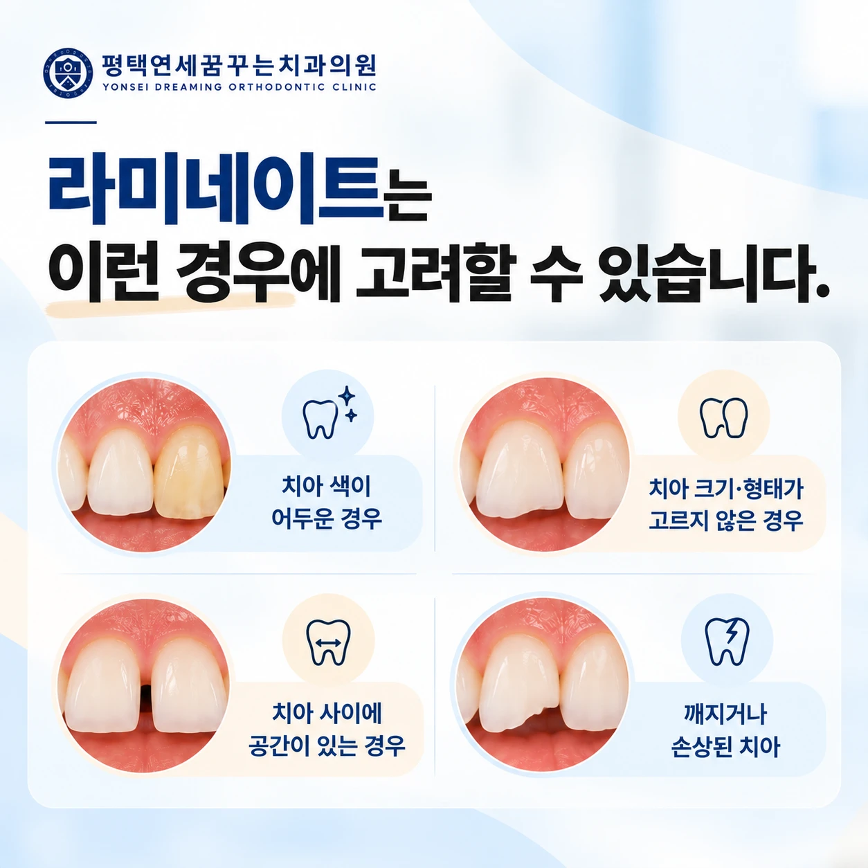 심미 진료 안내: 라미네이트는 치아미백과 무엇이 다를까요?