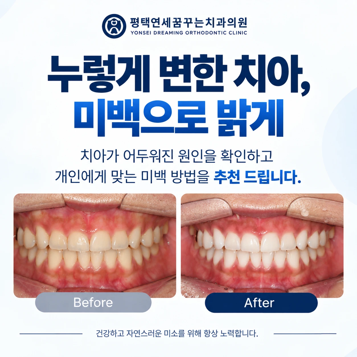 심미 치아가 누렇게 보이면 미백부터 진행하면 될까요?