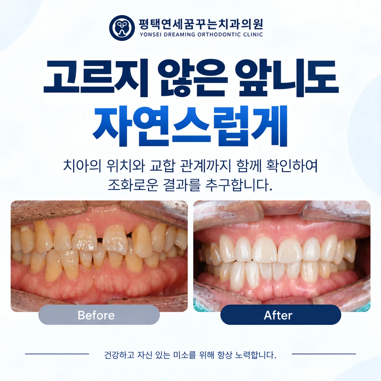 심미 앞니가 고르지 않다면 라미네이트로 바로 개선할 수 있을까요?