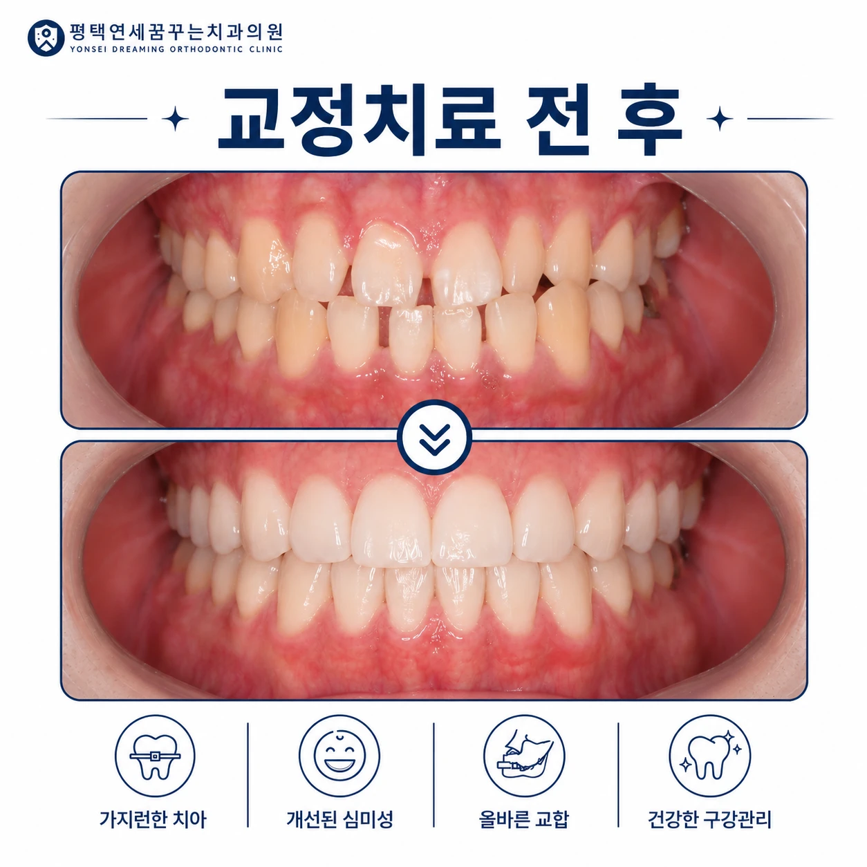 치과소개 교정은 왜 장치를 고르는 것부터 시작하지 않을까요?