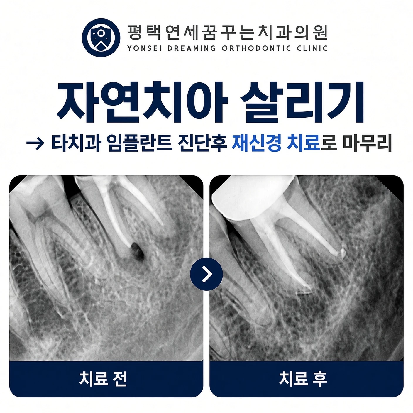 치과소개 손상이 큰 치아는 무조건 발치하고 임플란트를 해야 할까요?