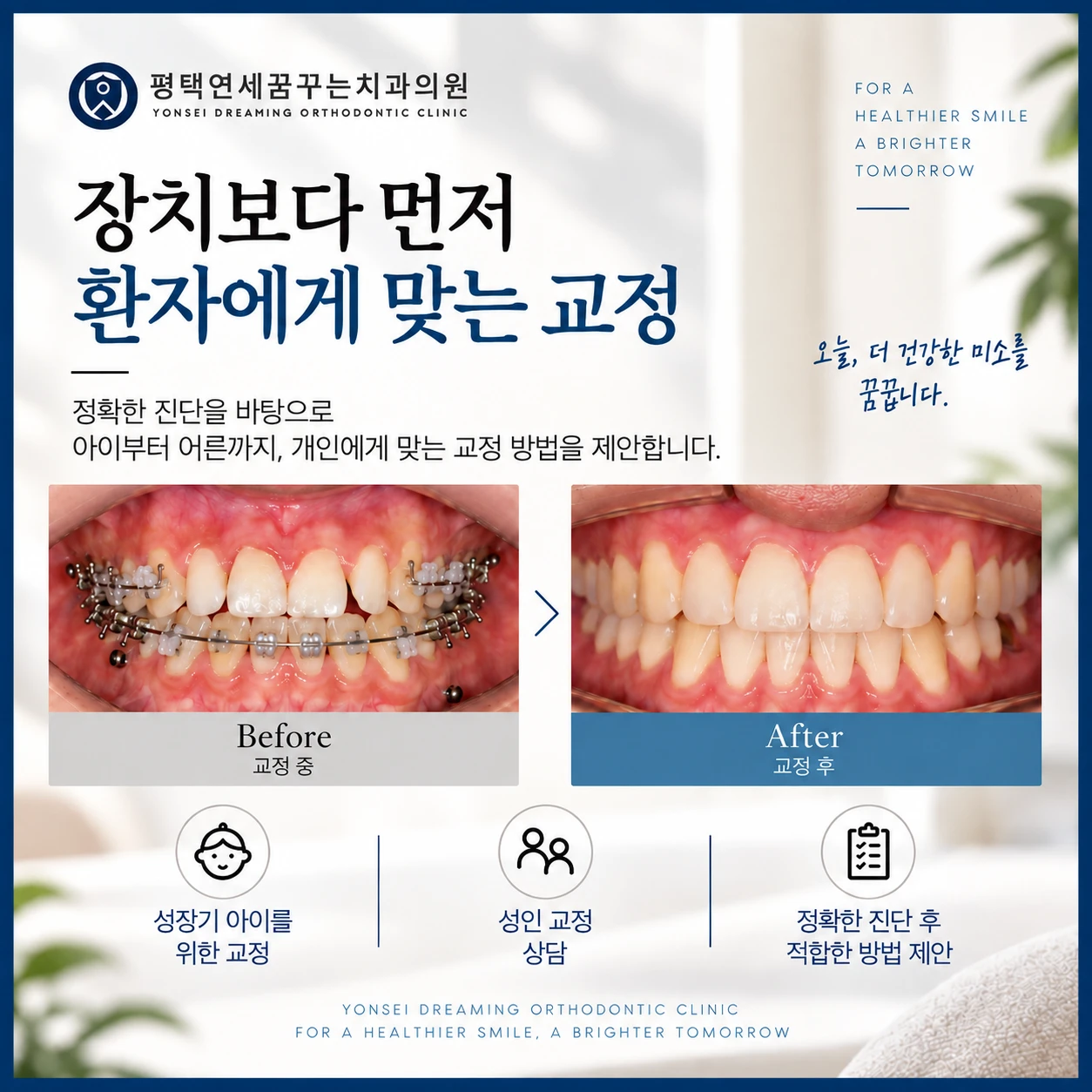 치아교정 진료 안내: 인비절라인이나 프리올소를 선택할 때 무엇을 기준으로 판단했을까요?