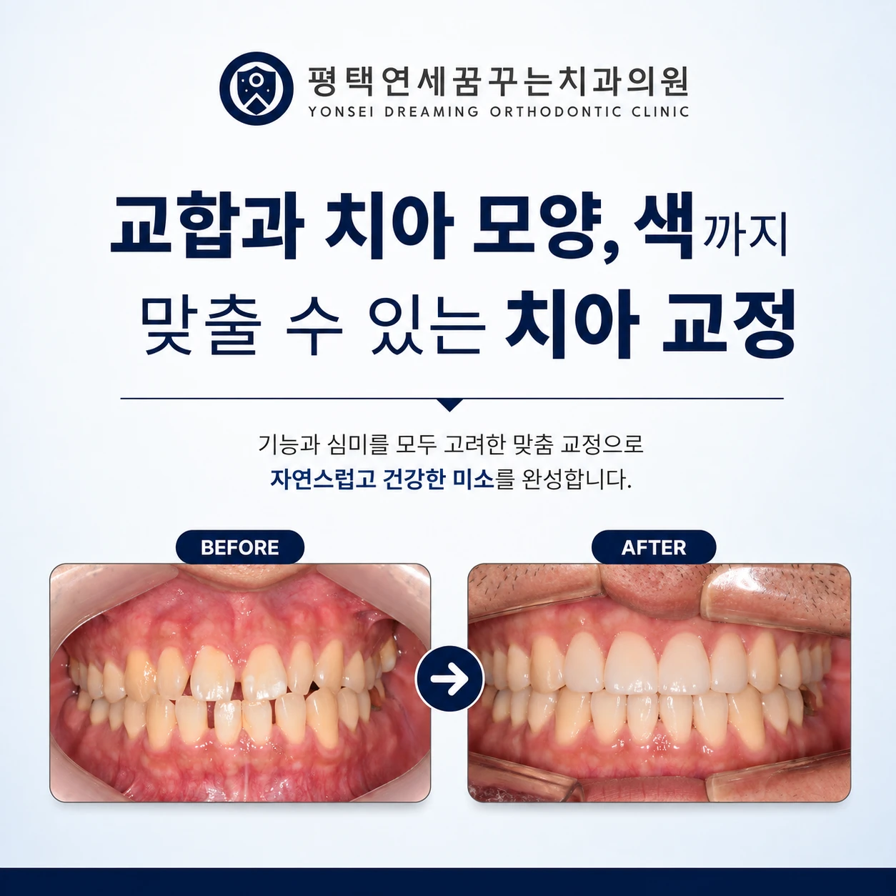 치아교정 장치를 제거한 뒤에도 교정이 끝났다고 볼 수 없는 이유는 무엇일까요?