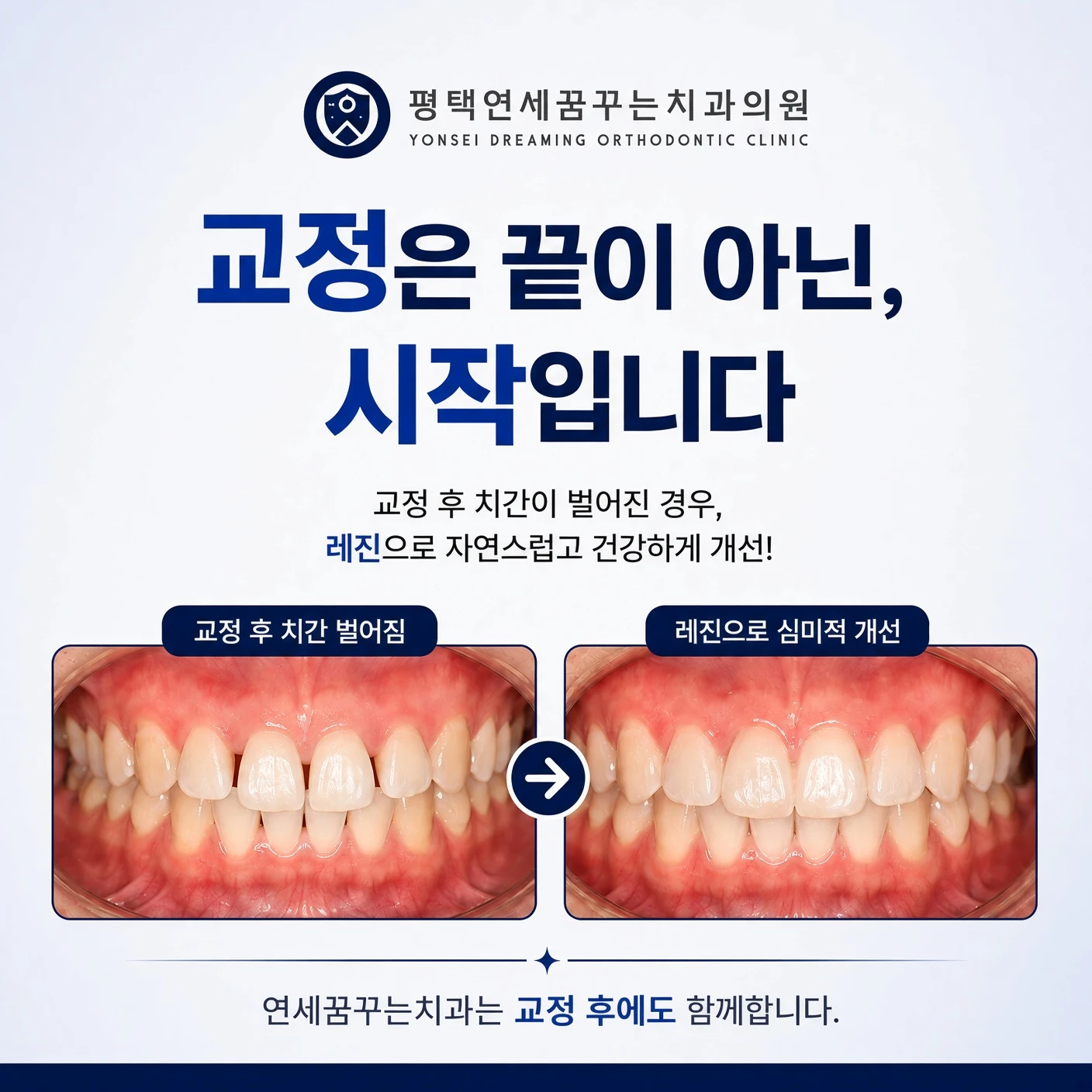 치아교정 장치를 제거한 뒤에도 교정이 끝났다고 볼 수 없는 이유는 무엇일까요?